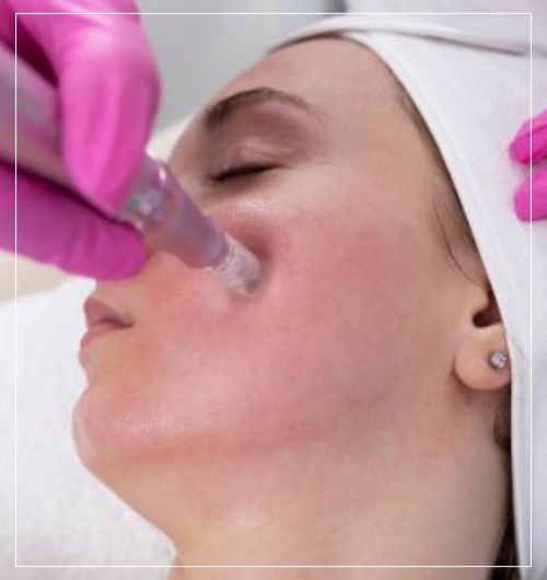 RF Microneedling At Wellness Center of Greater Cleveland, OH