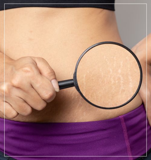 Stretch Marks At Wellness Center of Greater Cleveland, OH