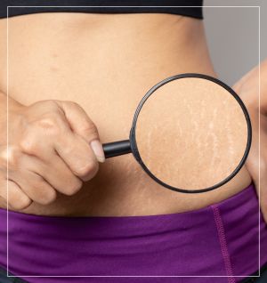 Stretch Marks At Wellness Center of Greater Cleveland, OH