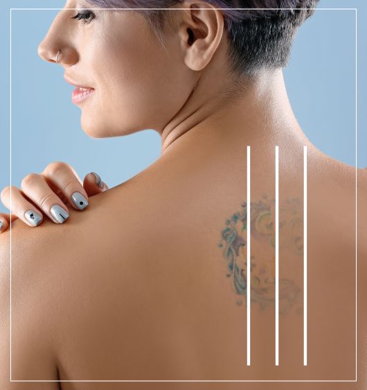 Tattoo Removal At Wellness Center of Greater Cleveland, OH